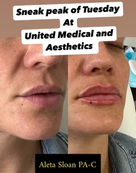 Lips B&A - c