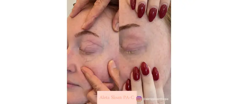 Co2 laser resurfacing