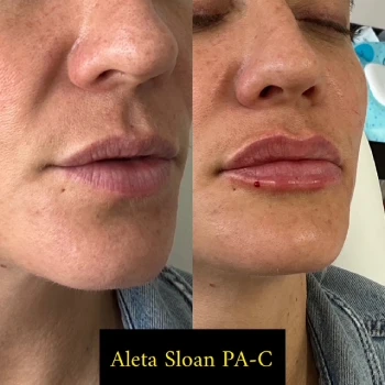 Revanesse Lips a