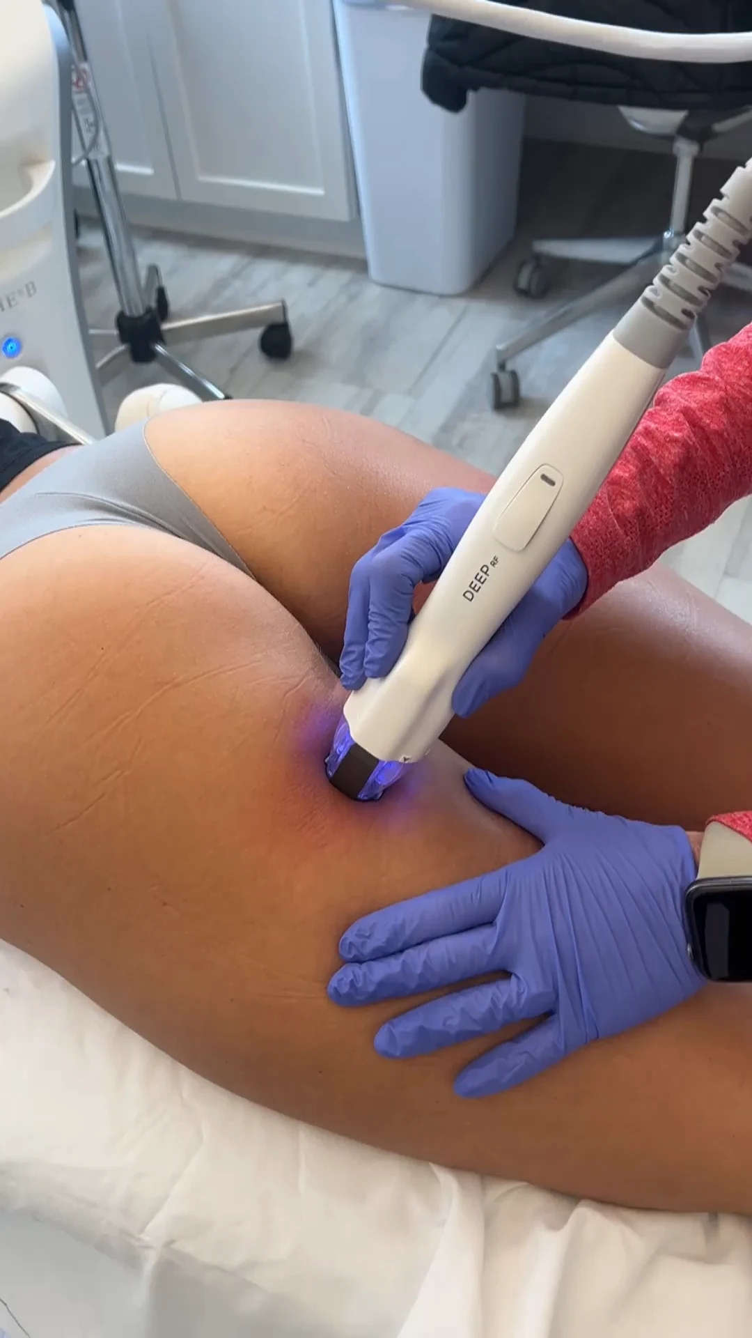Virtue RF Microneedling