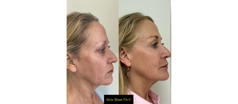 HELIX CO2 Laser Rejuvenation in Wilmington NC