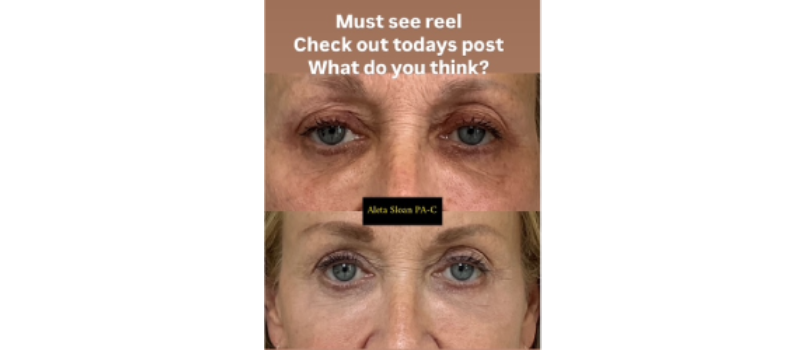 HELIX CO2 Laser Rejuvenation in Wilmington NC