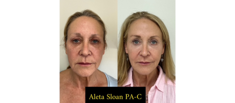 HELIX CO2 Laser Rejuvenation in Wilmington NC