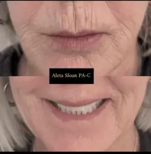Expert Lip Line Treatment