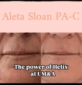 Expert Lip Line Treatment