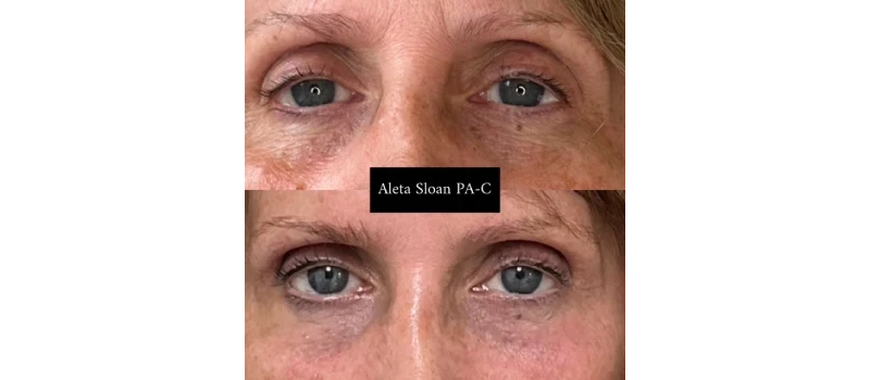 Co2 laser resurfacing