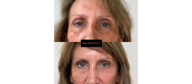 Co2 laser resurfacing