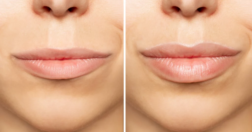 Women taking Lip Line Treatment in Wilmington, NC