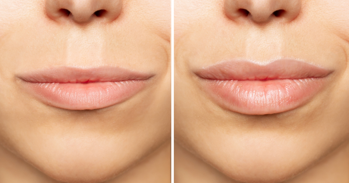 Women taking Lip Line Treatment in Wilmington, NC