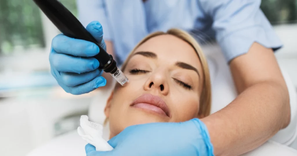 A women Receiving Exceed Microneedling in Wilmington, NC