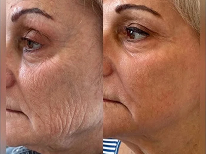 Before-After-CO2-Laser-Resurfacing-United-Medical-and-Aesthetics-Eight