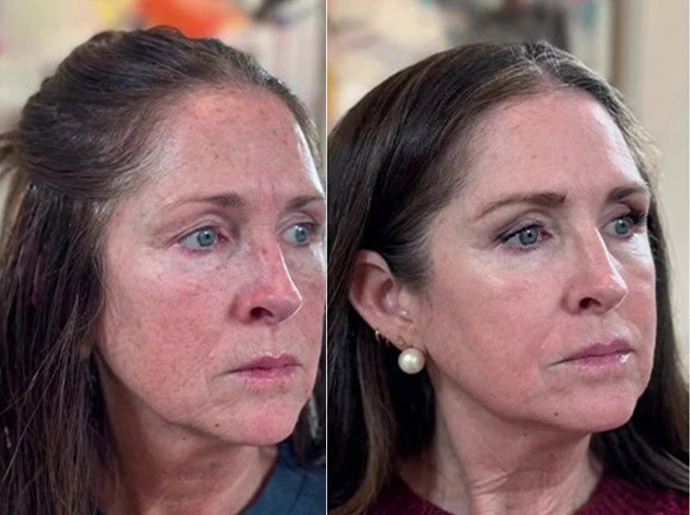 Before-After-CO2-Laser-Resurfacing-United-Medical-and-Aesthetics-Eleven