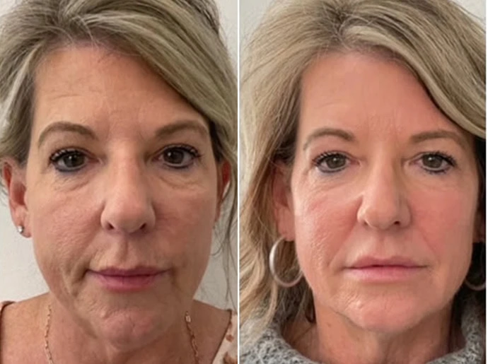 Before-After-CO2-Laser-Resurfacing-United-Medical-and-Aesthetics-Four