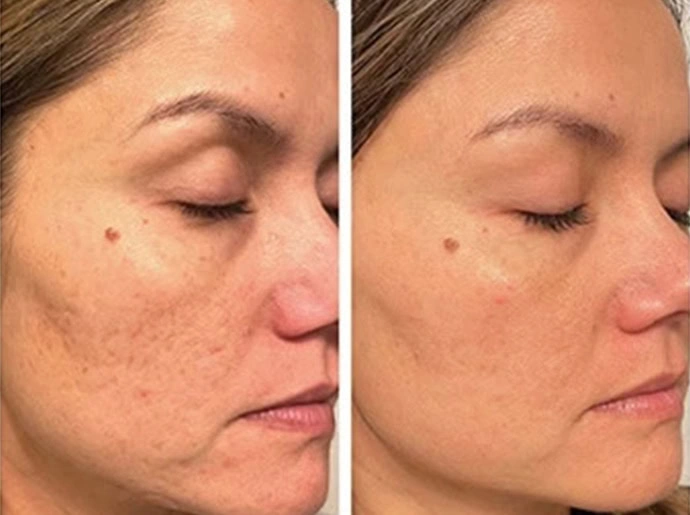 Before-After-CO2-Laser-Resurfacing-United-Medical-and-Aesthetics-Seven