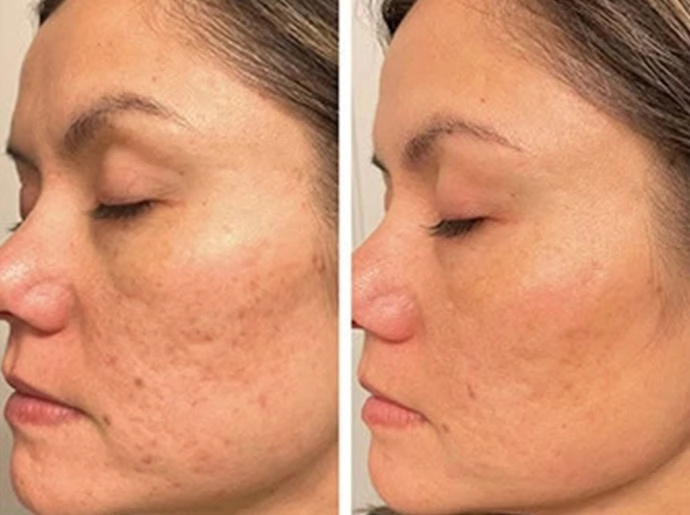 Before-After-CO2-Laser-Resurfacing-United-Medical-and-Aesthetics-Six