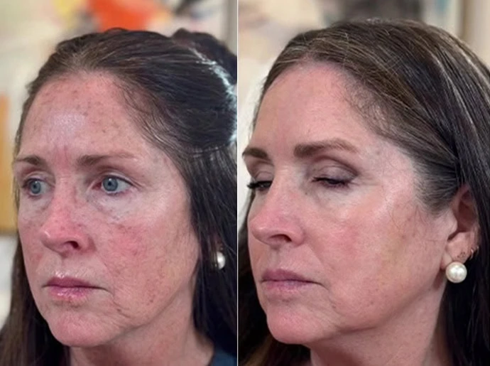 Before-After-CO2-Laser-Resurfacing-United-Medical-and-Aesthetics-Ten