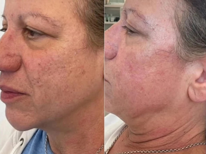 Before-After-CO2-Laser-Resurfacing-United-Medical-and-Aesthetics-Three