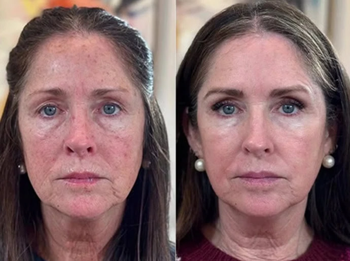 Before-After-CO2-Laser-Resurfacing-United-Medical-and-Aesthetics-Twelve