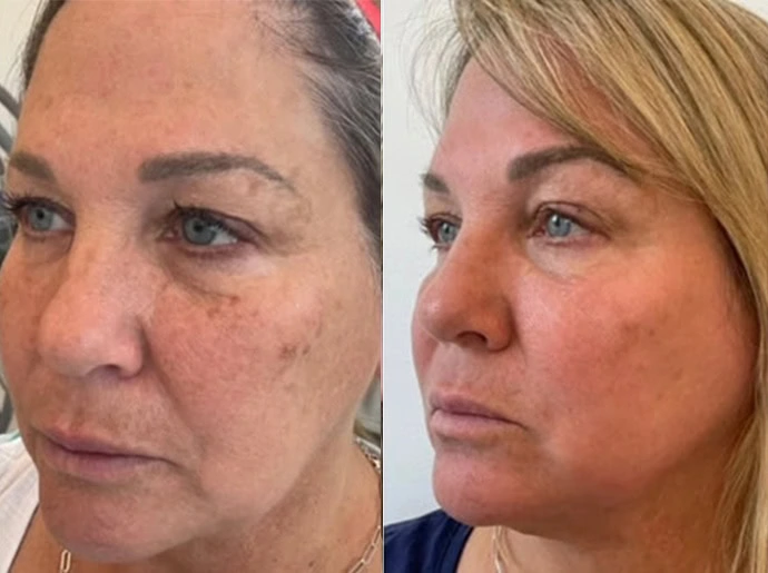 Before-After-CO2-Laser-Resurfacing-United-Medical-and-Aesthetics-Two