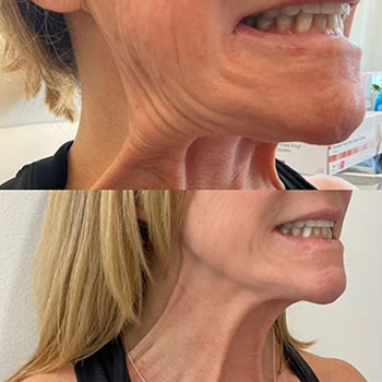 Neuromodulators-b&a-four