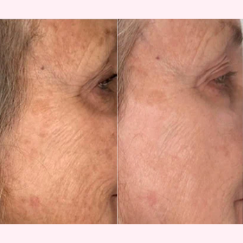 Nordyls-Light-and-Bright-b&a-four
