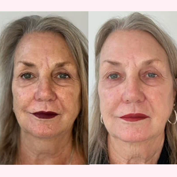 Nordyls-Light-and-Bright-b&a-seven
