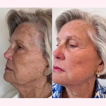 Nordyls-Light-and-Bright-b&a-six