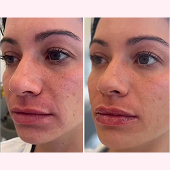 revanesse-versa-b&a-six