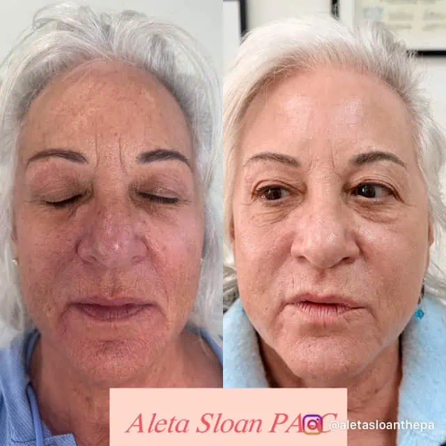 UltraClear Laser Treatment in Wilmington, NC