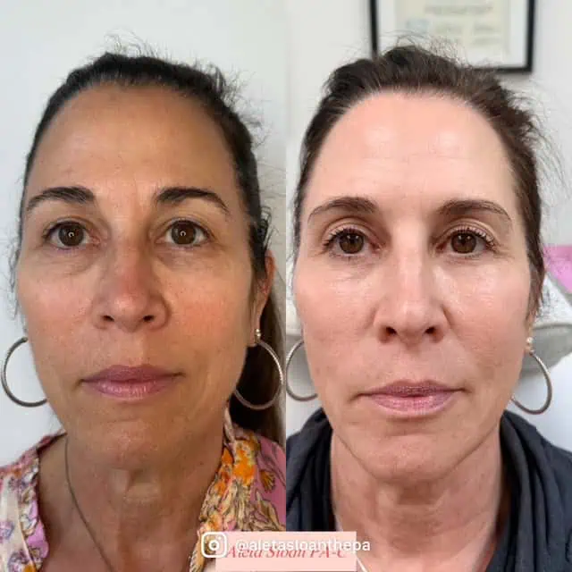 UltraClear Laser Treatment in Wilmington, NC