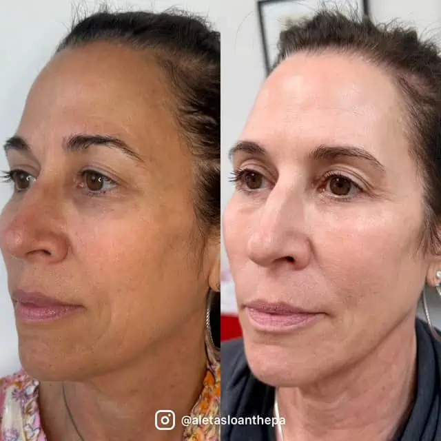 UltraClear Laser Treatment in Wilmington, NC