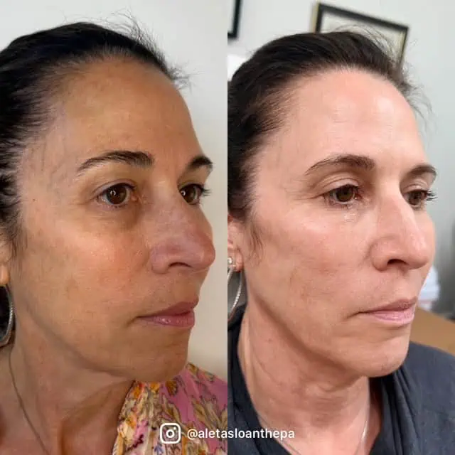 UltraClear Laser Treatment in Wilmington, NC