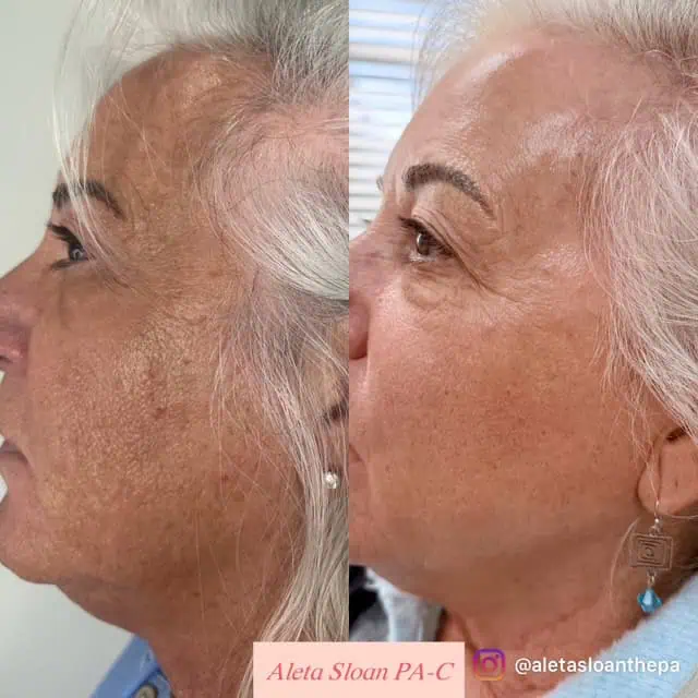 UltraClear Laser Treatment in Wilmington, NC