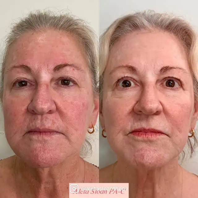 UltraClear Laser Treatment in Wilmington, NC