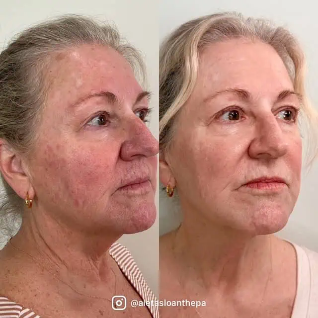 UltraClear Laser Treatment in Wilmington, NC