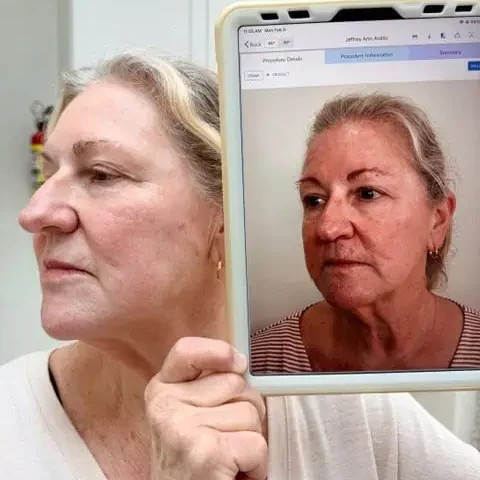 UltraClear Laser Treatment in Wilmington, NC