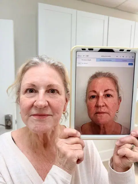 UltraClear Laser Treatment in Wilmington, NC