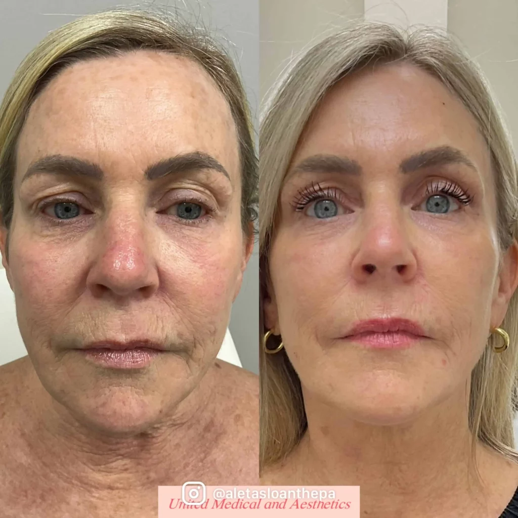 UltraClear® Laser Resurfacing