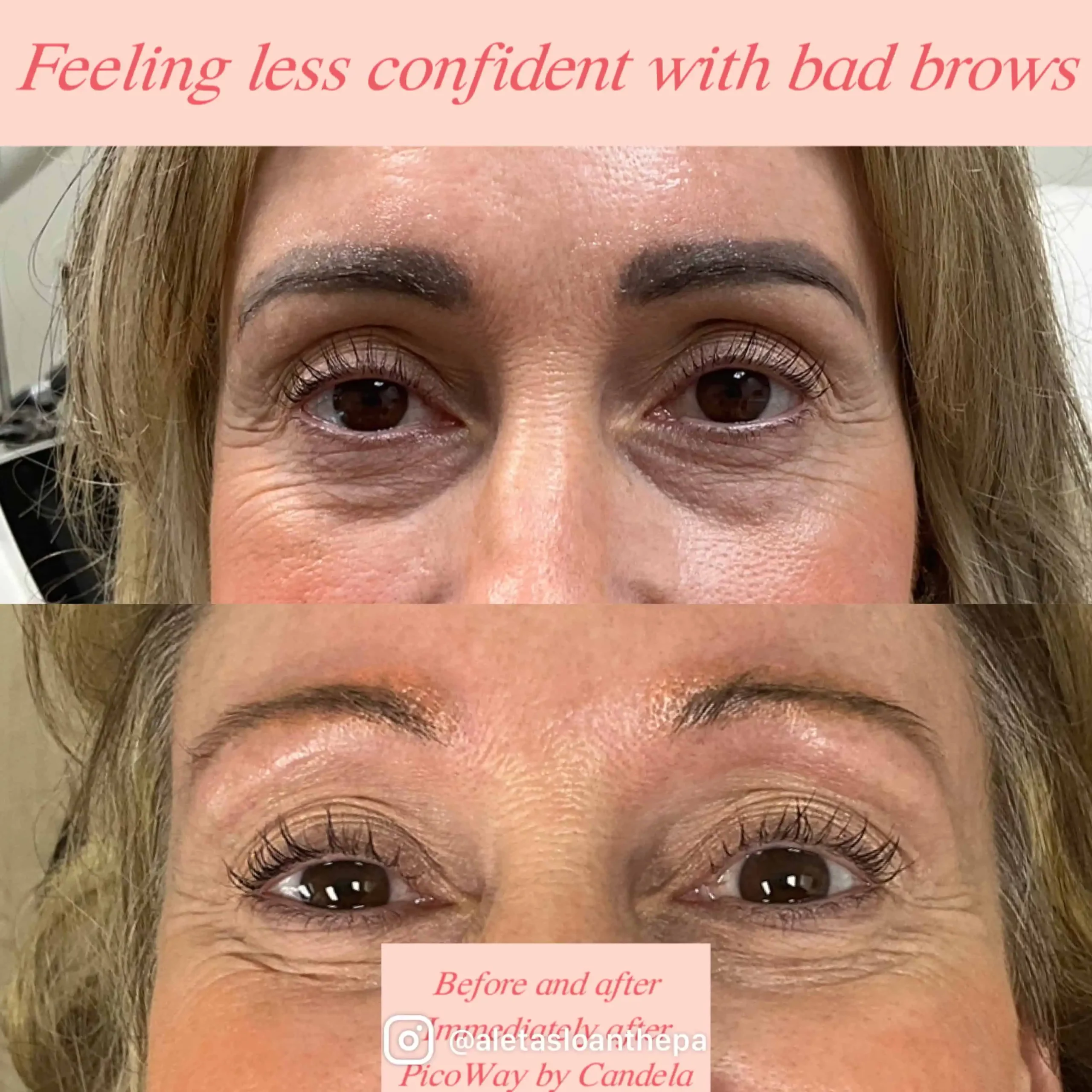 picoway-laser-before-after-a