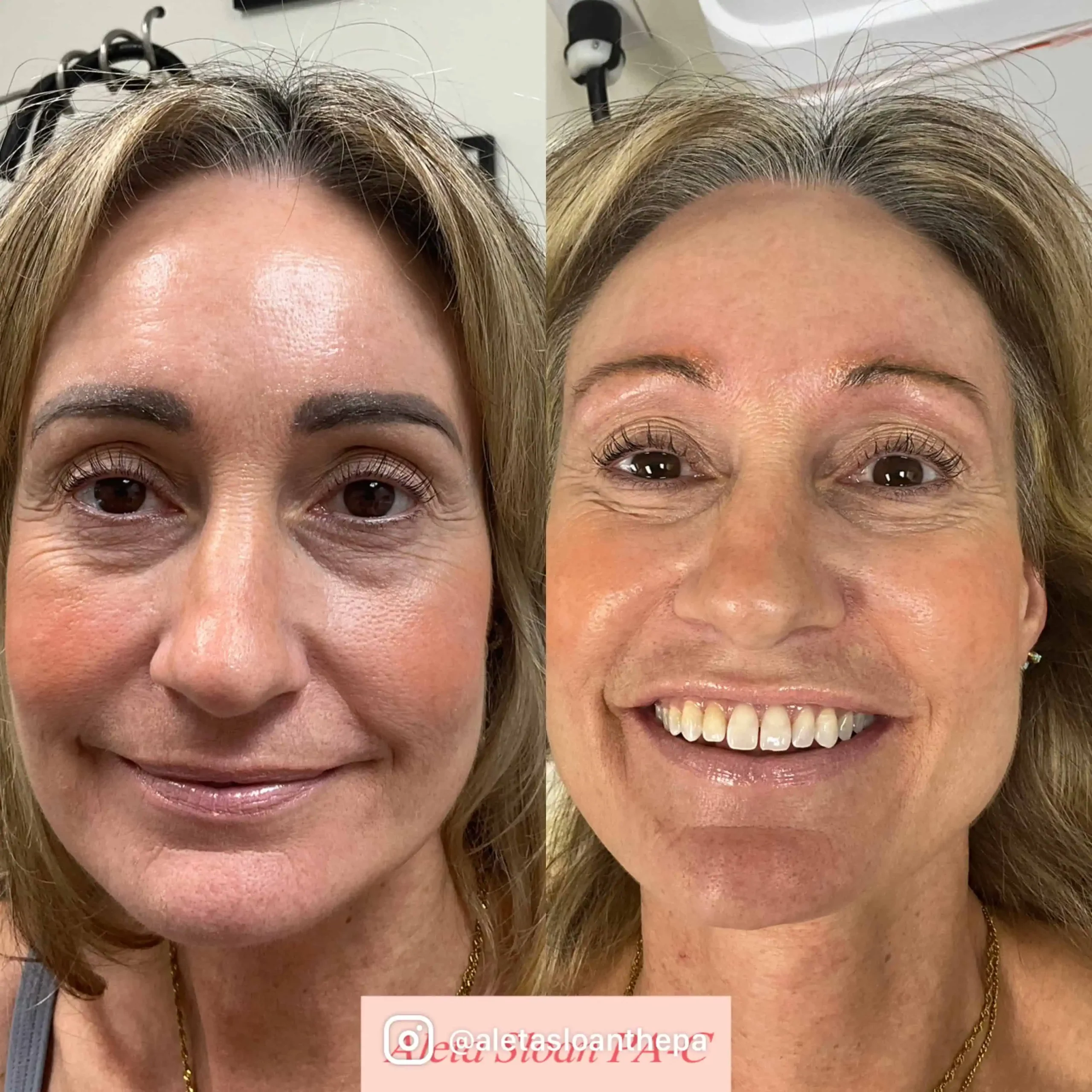 picoway-laser-before-after-b