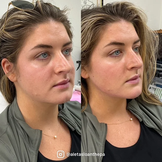 Filler before after aleta sloan