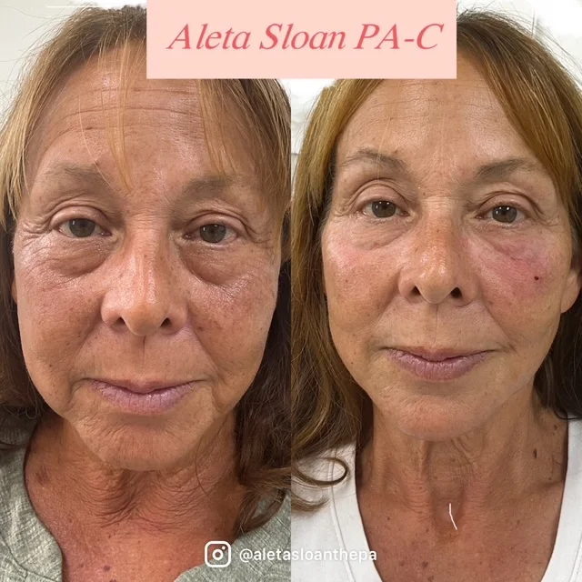 dermal-filler-new-1