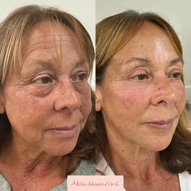 dermal-filler-new-2