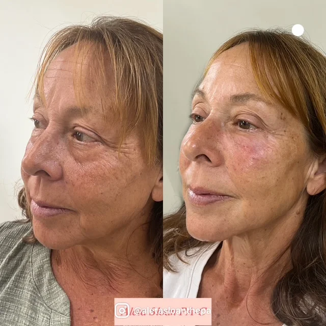 dermal-filler-new-3