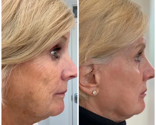 best fillers for face
