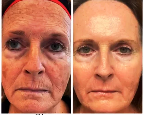 microneedling facial