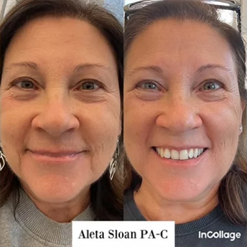dermal fillers