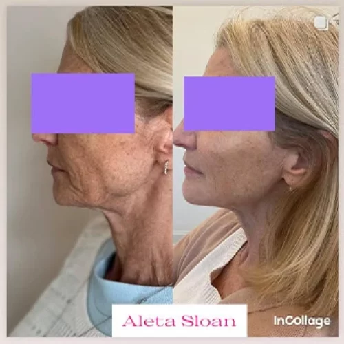 Dermal Filler in Wilmington, NC | United