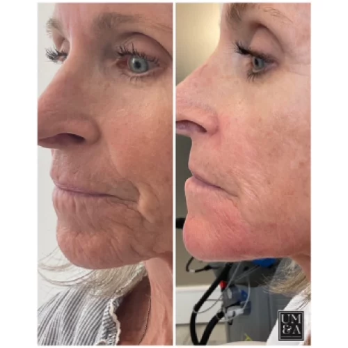 dermal filler injections