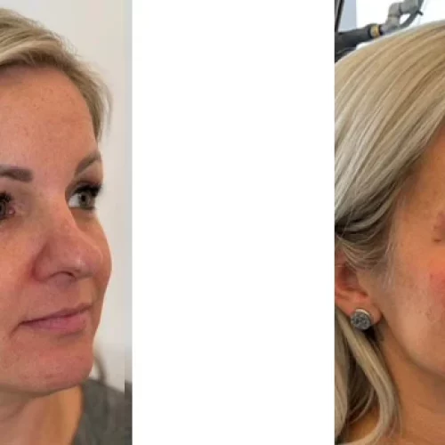 dermal fillers
